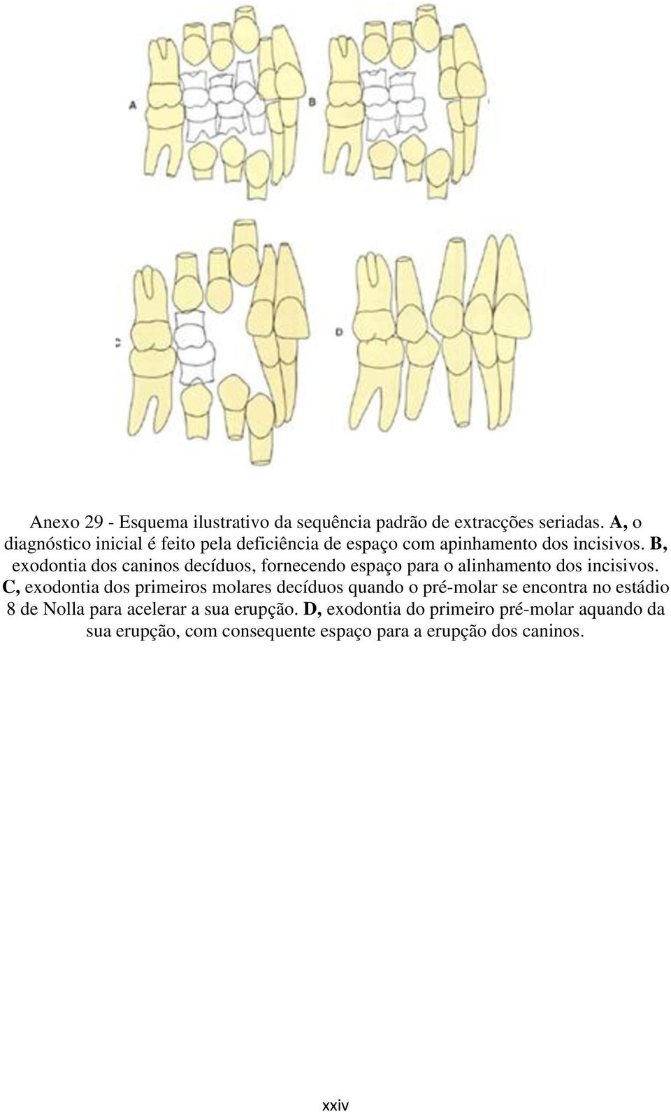 B, exodontia dos caninos decíduos, fornecendo espaço para o alinhamento dos incisivos.
