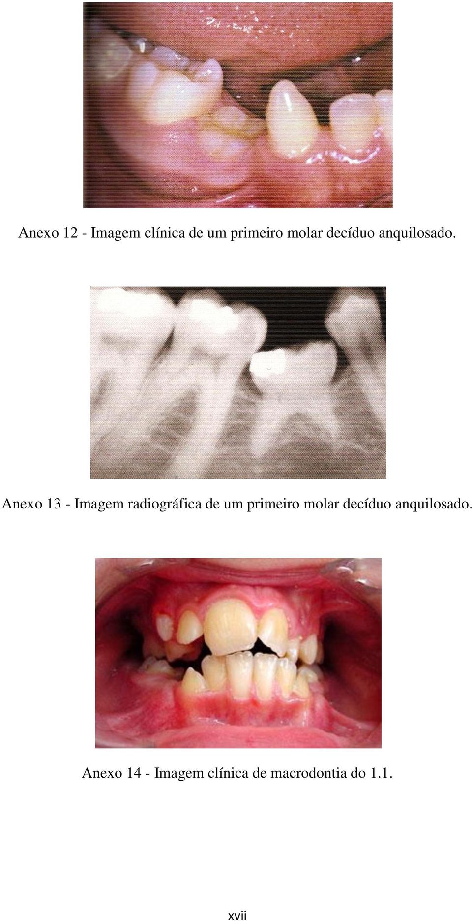 Anexo 13 - Imagem radiográfica de um primeiro
