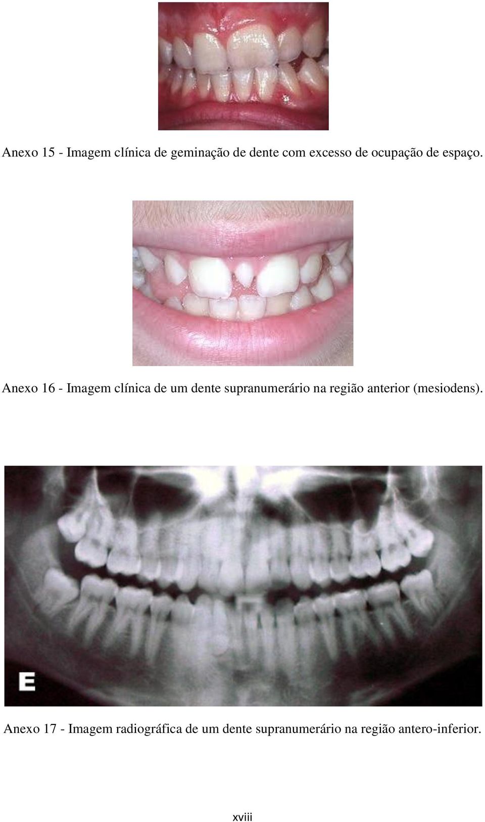 Anexo 16 - Imagem clínica de um dente supranumerário na região