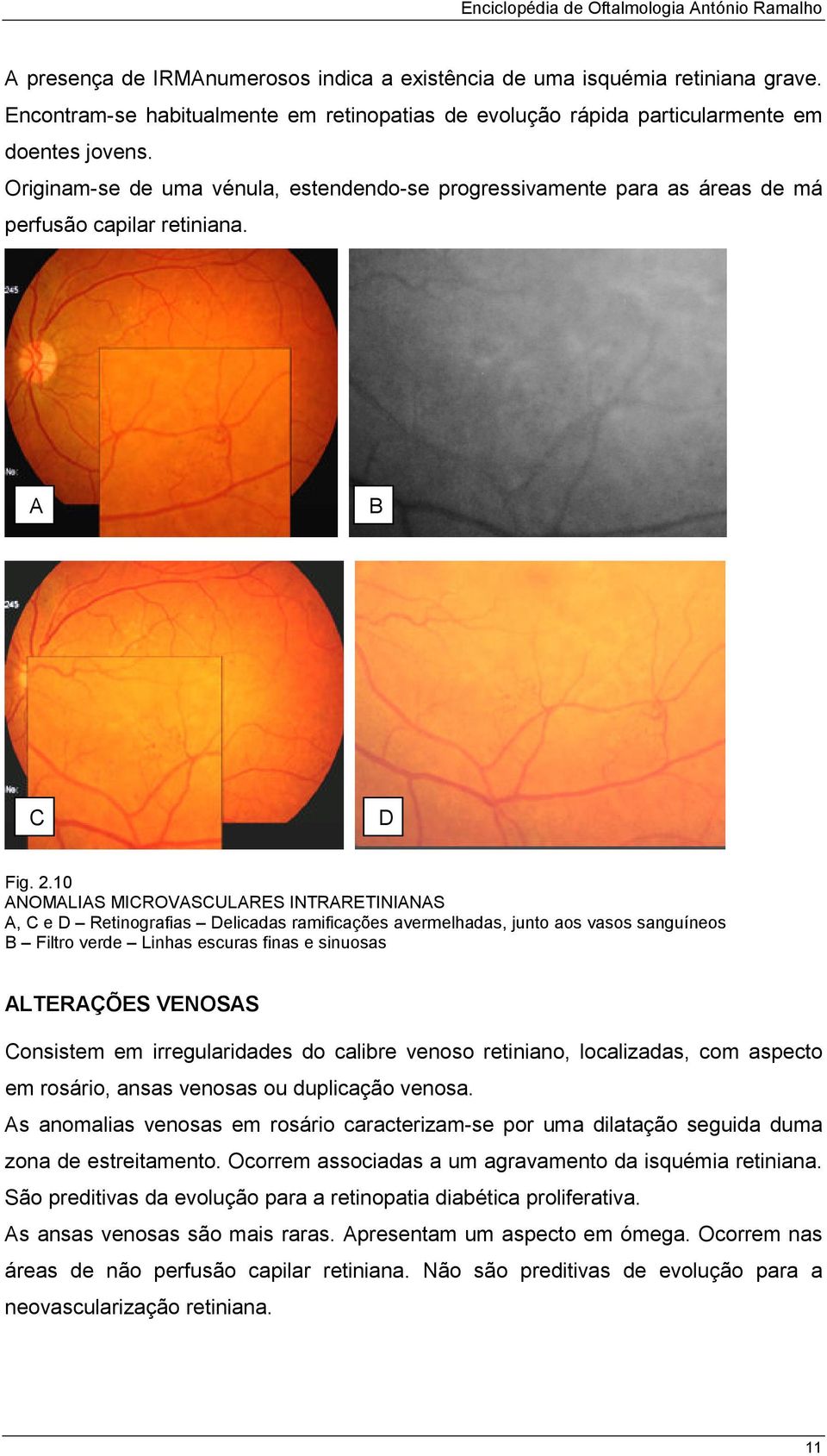 10 NOMLIS MIROVSULRES INTRRETININS, e Retinografias elicadas ramificações avermelhadas, junto aos vasos sanguíneos Filtro verde Linhas escuras finas e sinuosas LTERÇÕES VENOSS onsistem em