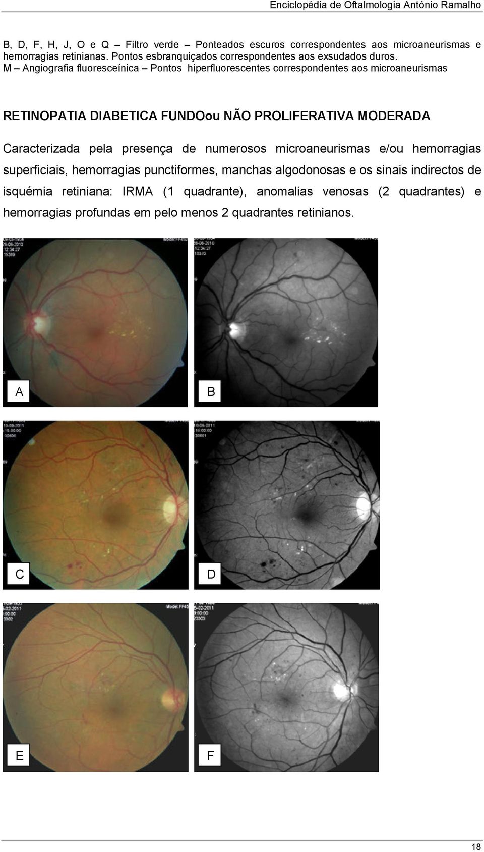 M ngiografia fluoresceínica Pontos hiperfluorescentes correspondentes aos microaneurismas RETINOPTI IETI FUNOou NÃO PROLIFERTIV MOER aracterizada pela