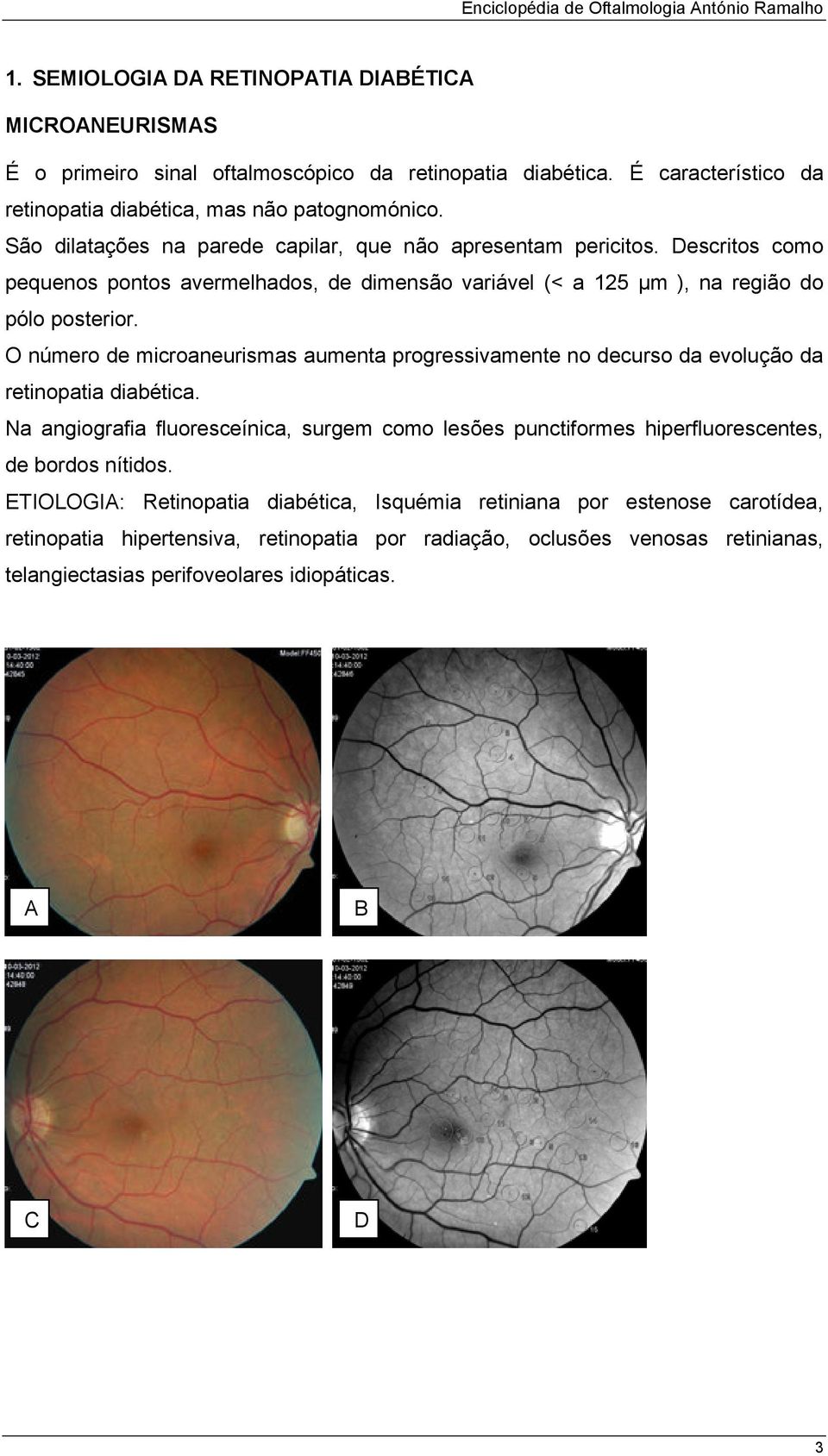 O número de microaneurismas aumenta progressivamente no decurso da evolução da retinopatia diabética.