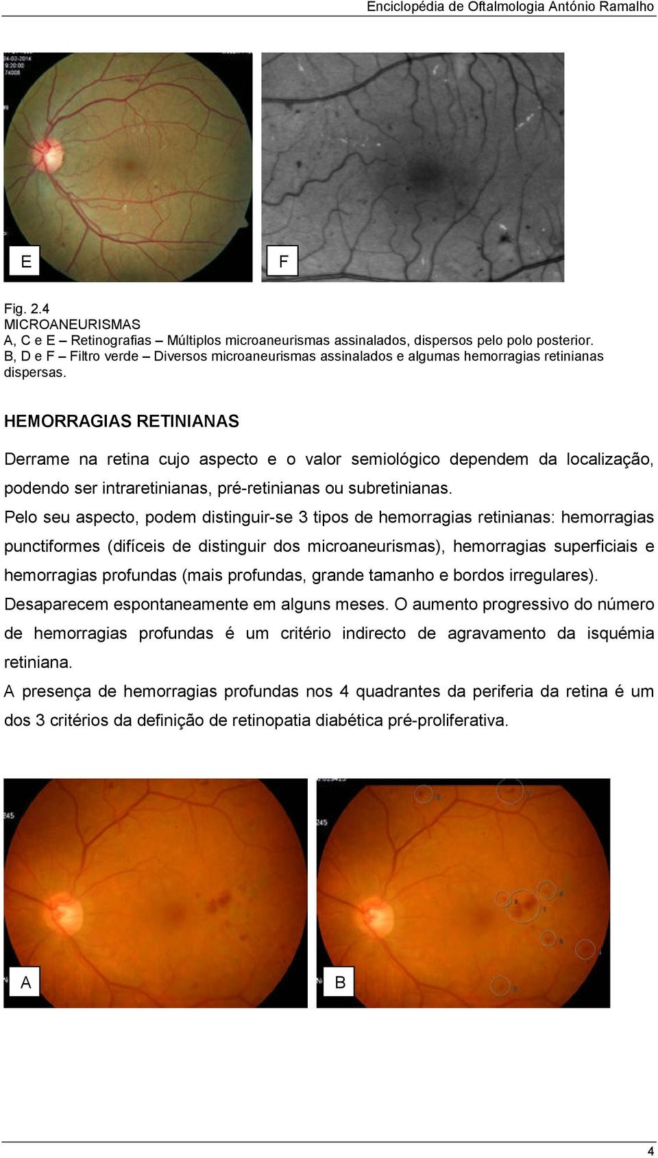 HEMORRGIS RETININS errame na retina cujo aspecto e o valor semiológico dependem da localização, podendo ser intraretinianas, pré-retinianas ou subretinianas.