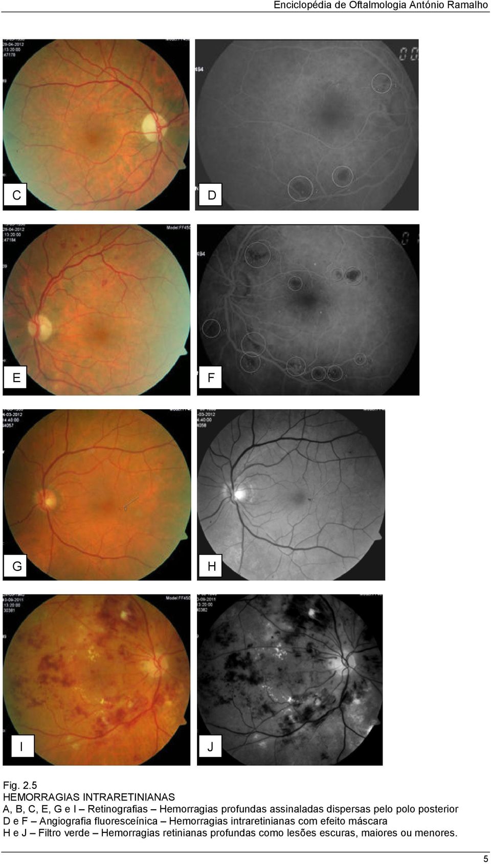 assinaladas dispersas pelo polo posterior e F ngiografia fluoresceínica