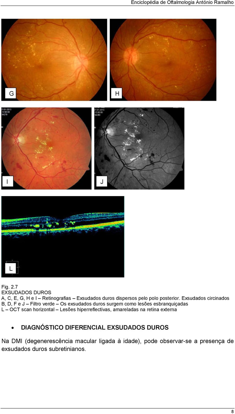 horizontal Lesões hiperreflectivas, amareladas na retina externa IGNÓSTIO IFERENIL EXSUOS UROS Na MI
