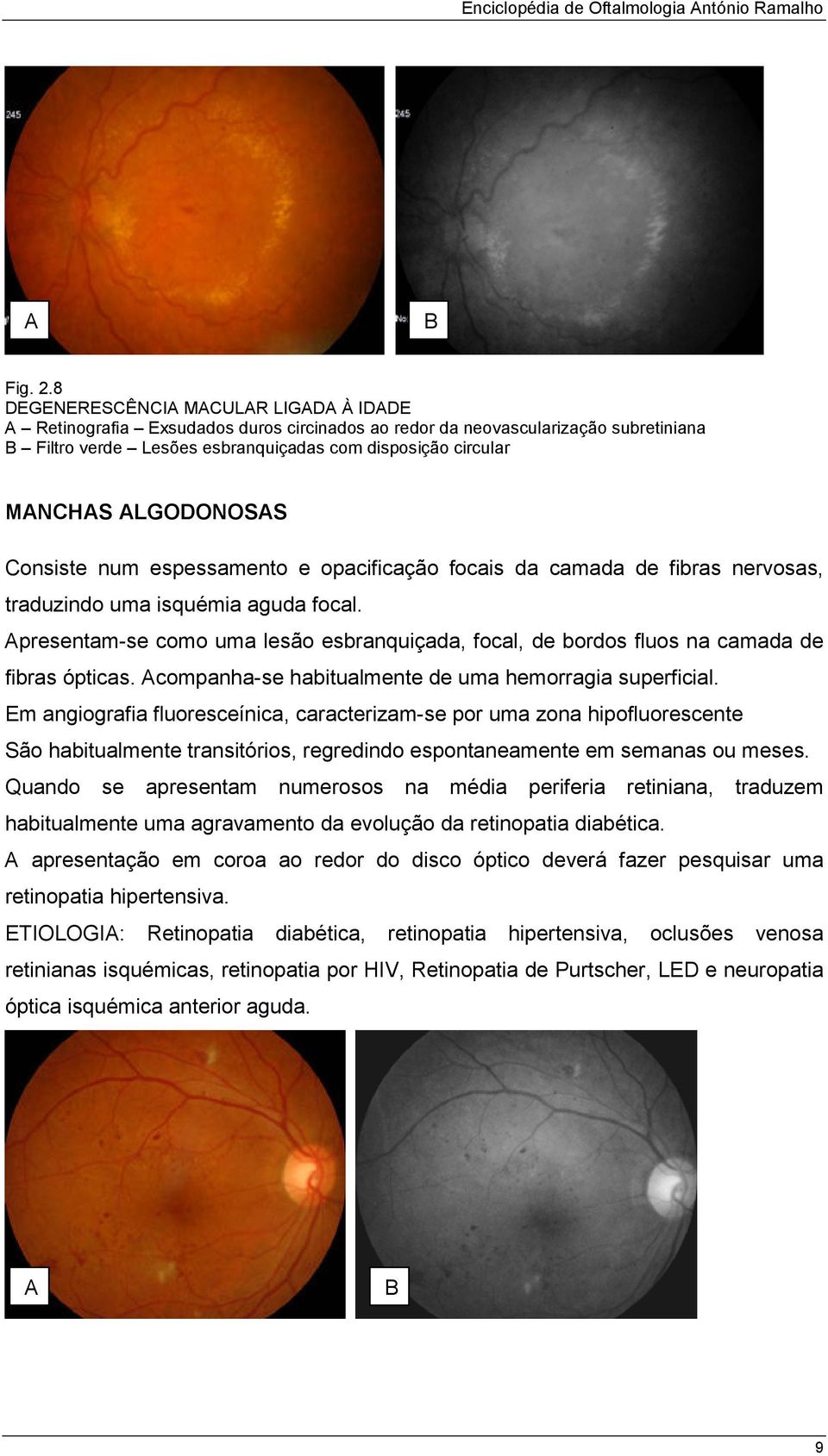 espessamento e opacificação focais da camada de fibras nervosas, traduzindo uma isquémia aguda focal. presentam-se como uma lesão esbranquiçada, focal, de bordos fluos na camada de fibras ópticas.