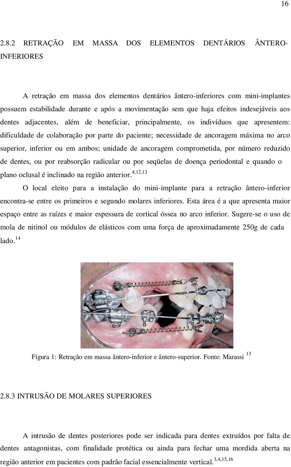 que haja efeitos indesejáveis aos dentes adjacentes, além de beneficiar, principalmente, os indivíduos que apresentem: dificuldade de colaboração por parte do paciente; necessidade de ancoragem