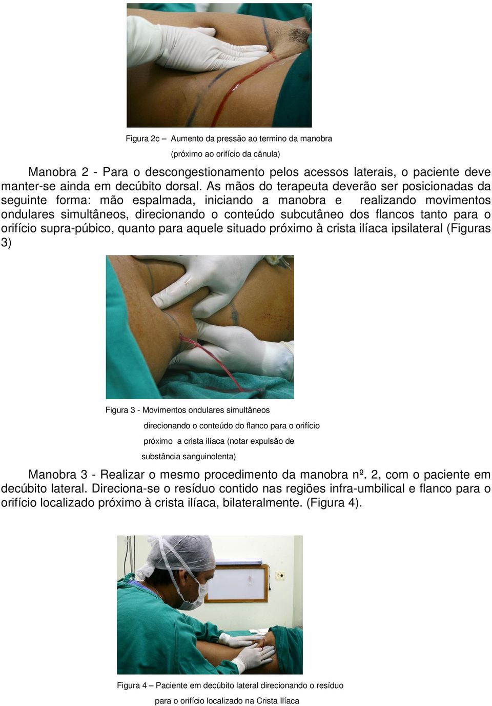 para o orifício supra-púbico, quanto para aquele situado próximo à crista ilíaca ipsilateral (Figuras ) Figura - Movimentos ondulares simultâneos direcionando o conteúdo do flanco para o orifício