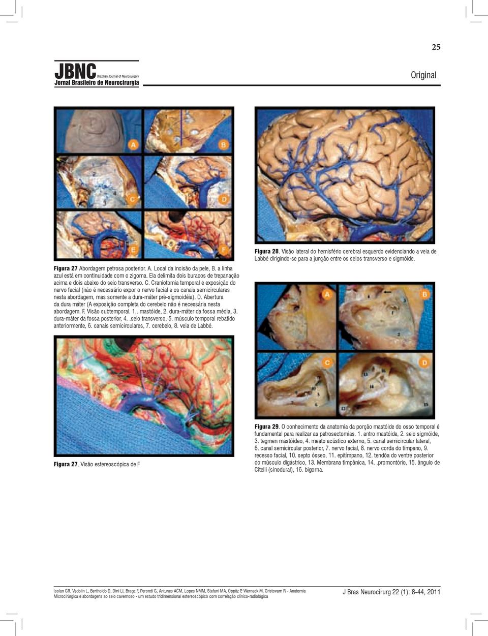 Craniotomia temporal e exposição do nervo facial (não é necessário expor o nervo facial e os canais semicirculares nesta abordagem, mas somente a dura-máter pré-sigmoidéia). D.