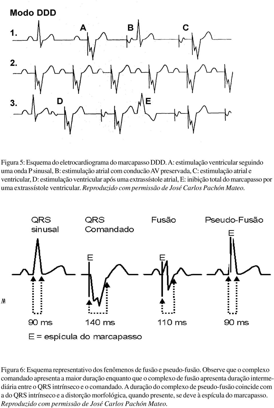 atrial, E: inibição total do marcapasso por uma extrassístole ventricular. Reproduzido com permissão de José Carlos Pachón Mateo.