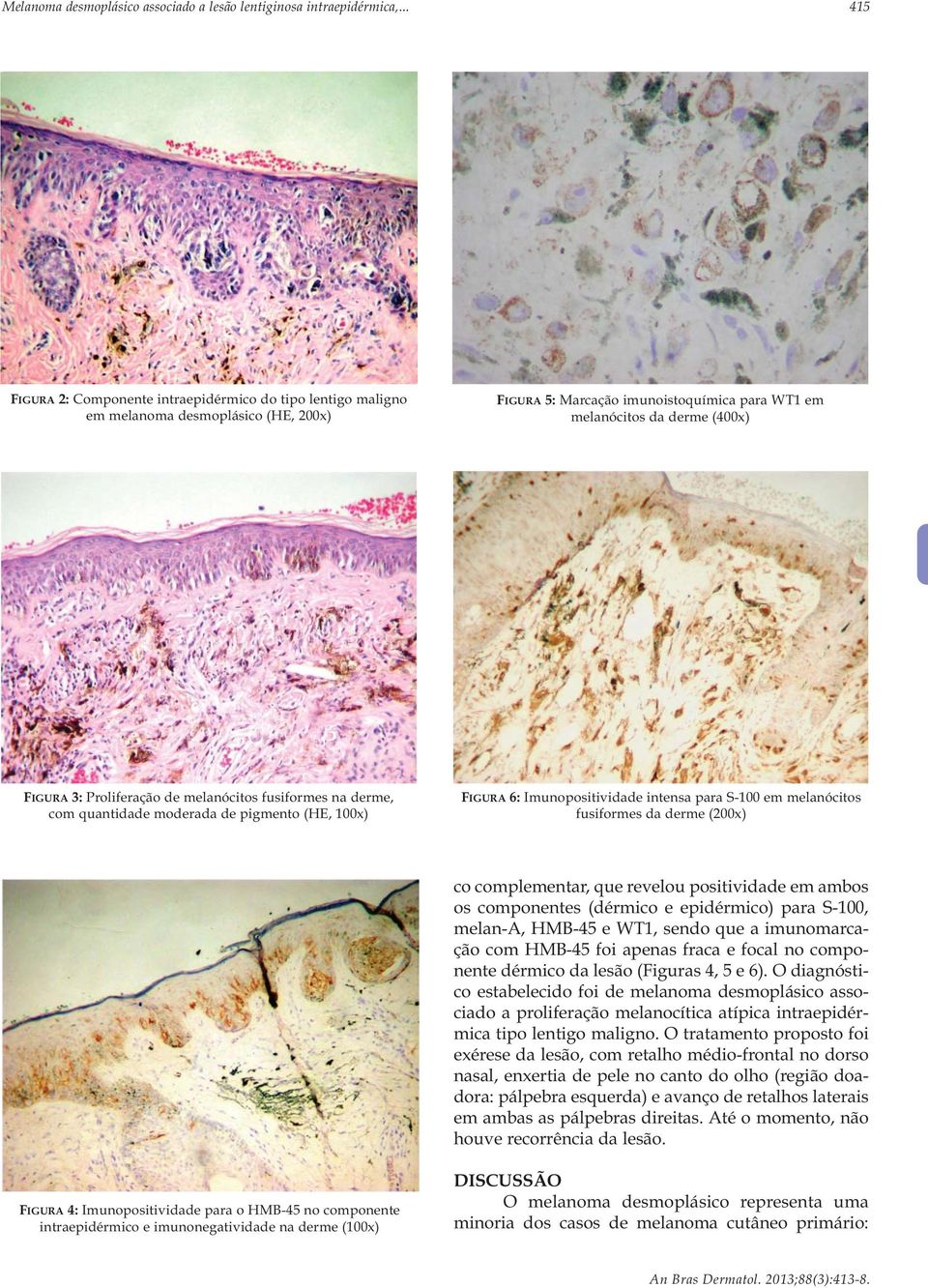 Proliferação de melanócitos fusiformes na derme, com quantidade moderada de pigmento (HE, 100x) FIGURA 6: Imunopositividade intensa para S-100 em melanócitos fusiformes da derme (200x) co