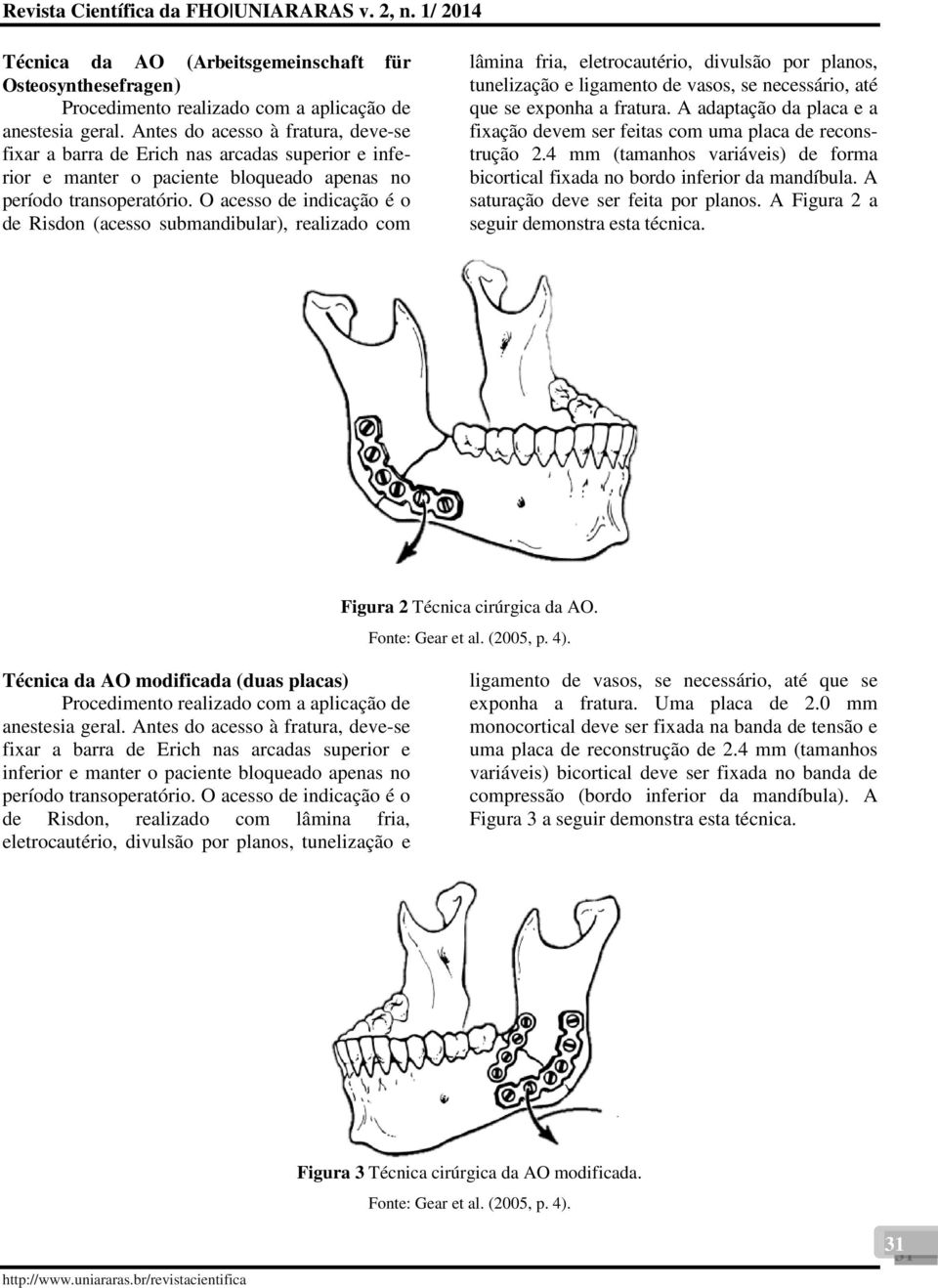 O acesso de indicação é o de Risdon (acesso submandibular), realizado com lâmina fria, eletrocautério, divulsão por planos, tunelização e ligamento de vasos, se necessário, até que se exponha a