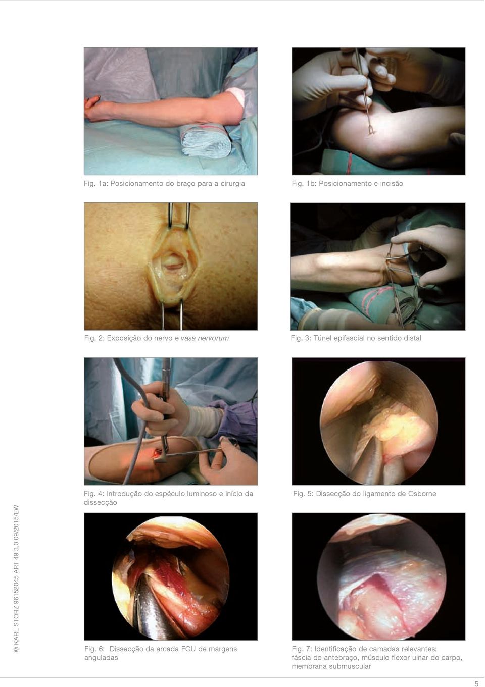 4: Introdução do espéculo luminoso e início da dissecção Fig.