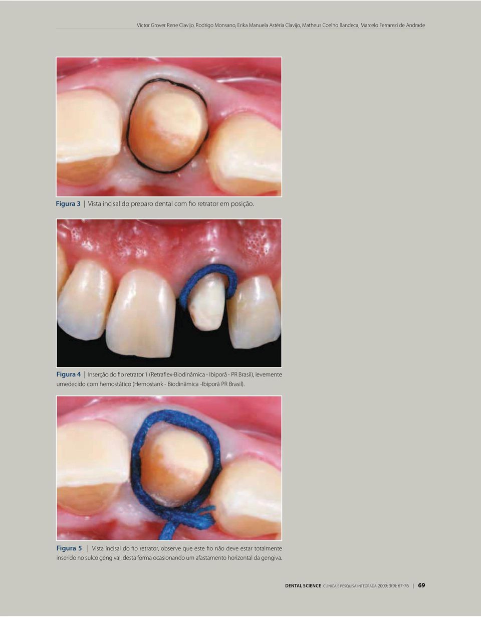 Figura 4 Inserção do fio retrator 1 (Retraflex-Biodinâmica - Ibiporã - PR Brasil), levemente umedecido com hemostático (Hemostank - Biodinâmica