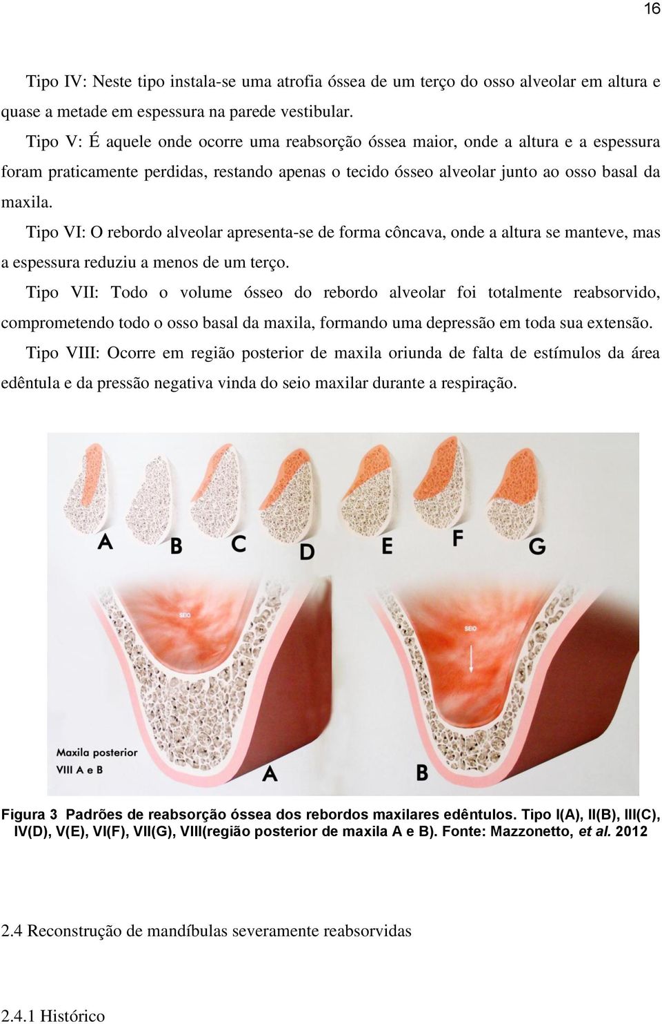 Tipo VI: O rebordo alveolar apresenta-se de forma côncava, onde a altura se manteve, mas a espessura reduziu a menos de um terço.