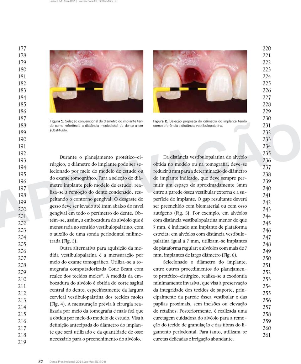 Durante o planejamento protético-cirúrgico, o diâmetro do implante pode ser selecionado por meio do modelo de estudo ou do exame tomográfico.