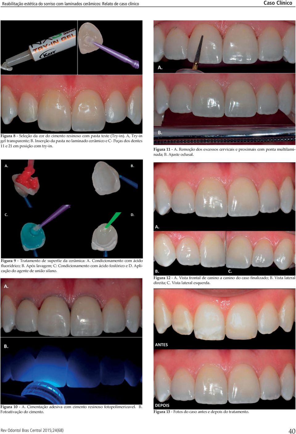 Ajuste oclusal. Figura 9 - Tratamento de superfíe da cerâmica: A. Condicionamento com ácido fluorídrico; B. Após lavagem; C: Condicionamento com ácido fosfórico e D.