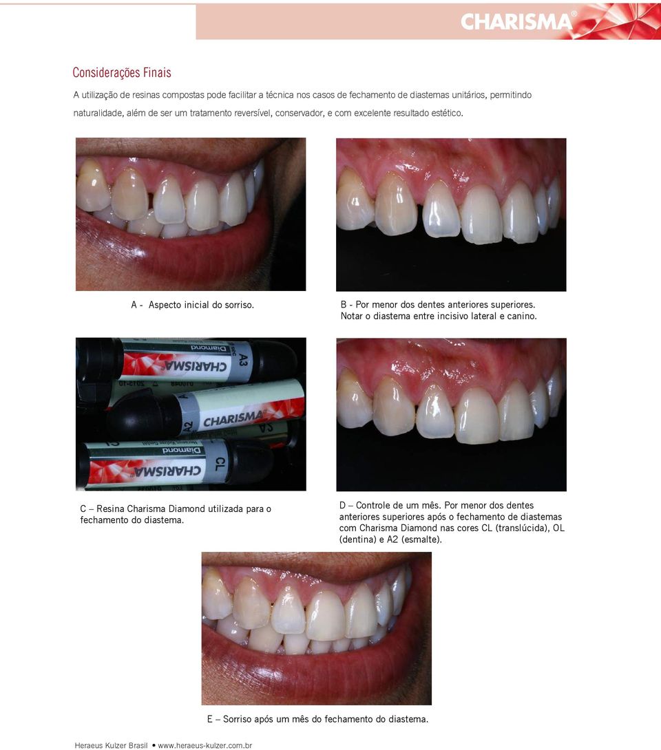 Notar o diastema entre incisivo lateral e canino. C Resina Charisma Diamond utilizada para o fechamento do diastema. D Controle de um mês.