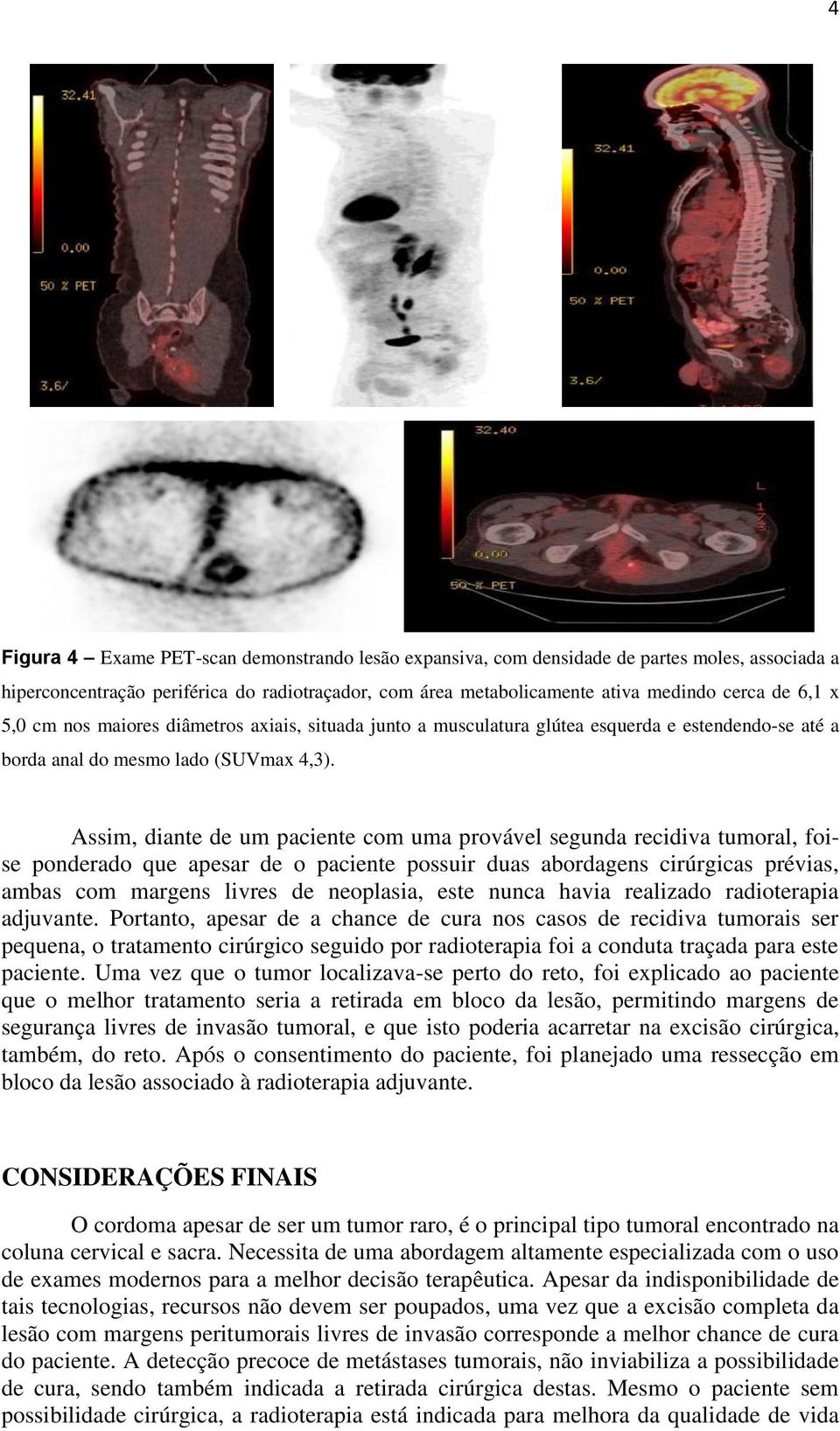 Assim, diante de um paciente com uma provável segunda recidiva tumoral, foise ponderado que apesar de o paciente possuir duas abordagens cirúrgicas prévias, ambas com margens livres de neoplasia,