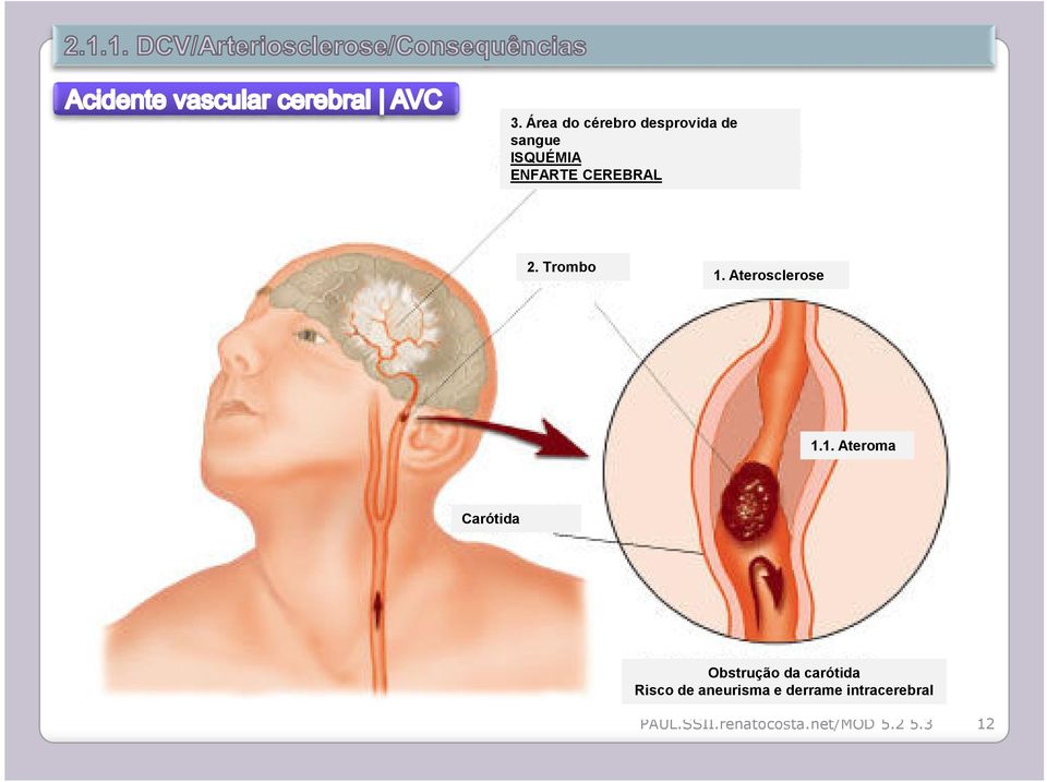Aterosclerose 1.