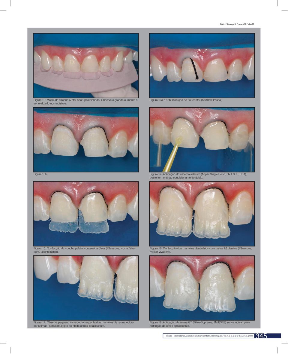 Figura 15: Confecção da concha palatal com resina Clear (4Seasons, Ivoclar Vivadent, Liechteinsten). Figura 16: Confecção dos mamelos dentinários com resina A3 dentina (4Seasons, Ivoclar Vivadent).