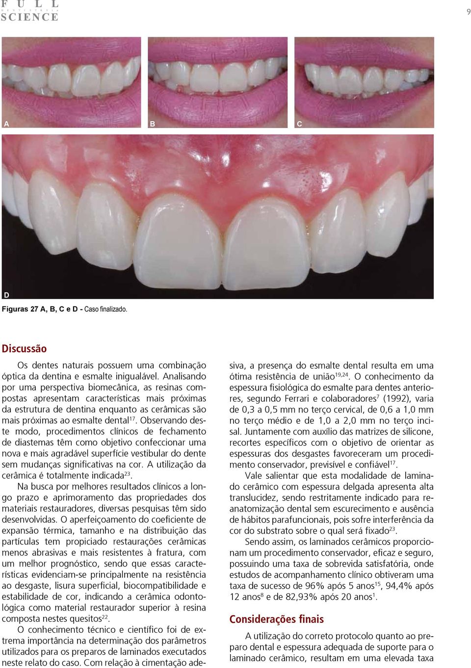 Observando deste modo, procedimentos clínicos de fechamento de diastemas têm como objetivo confeccionar uma nova e mais agradável superfície vestibular do dente sem mudanças significativas na cor.