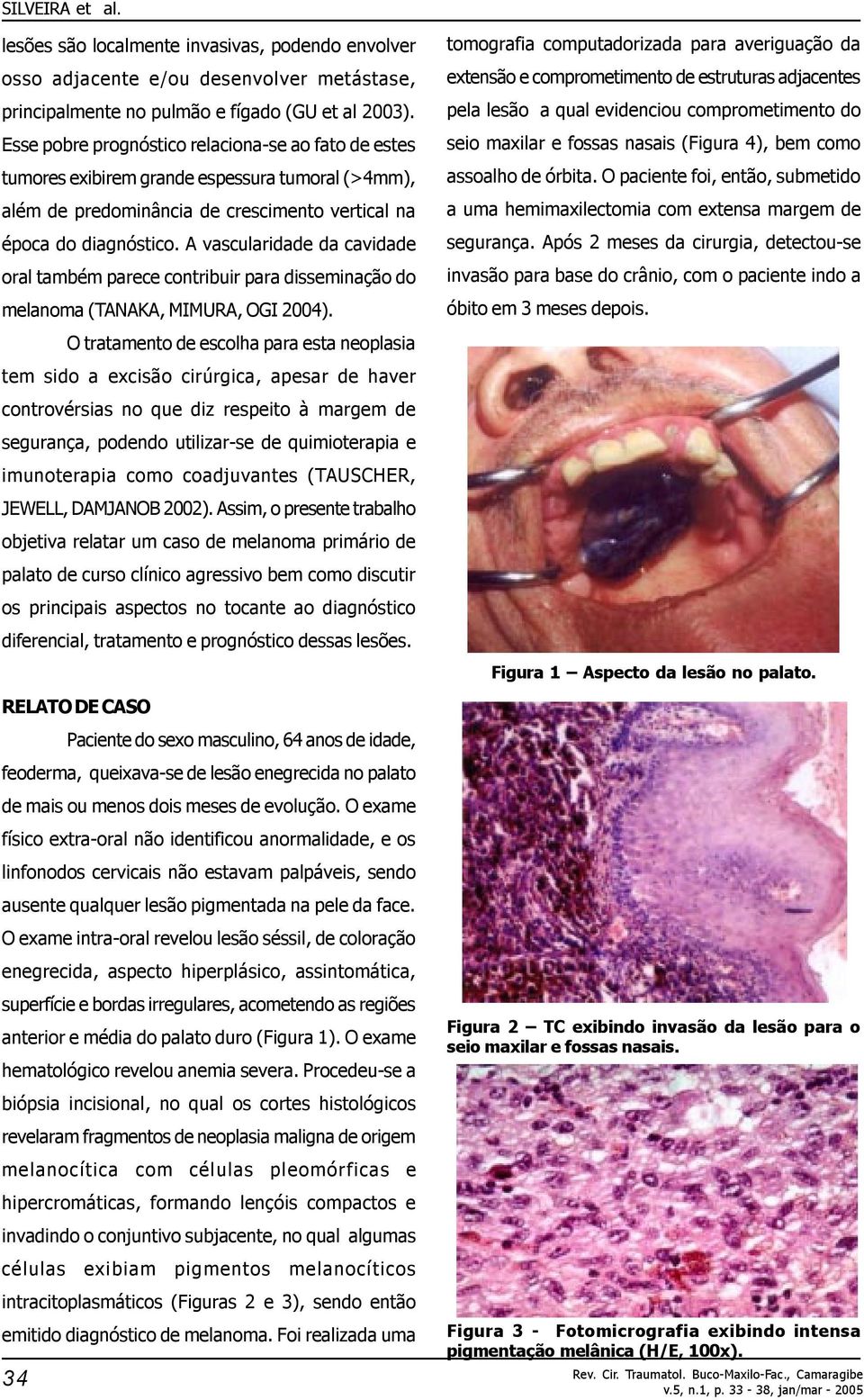 A vascularidade da cavidade oral também parece contribuir para disseminação do melanoma (TANAKA, MIMURA, OGI 2004).