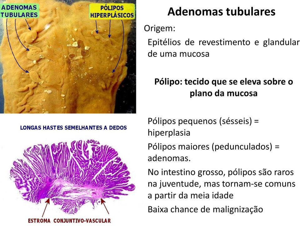 hiperplasia Pólipos maiores (pedunculados) = adenomas.