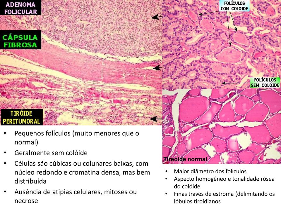 atipias celulares, mitoses ou necrose Tireóide normal Maior diâmetro dos folículos Aspecto