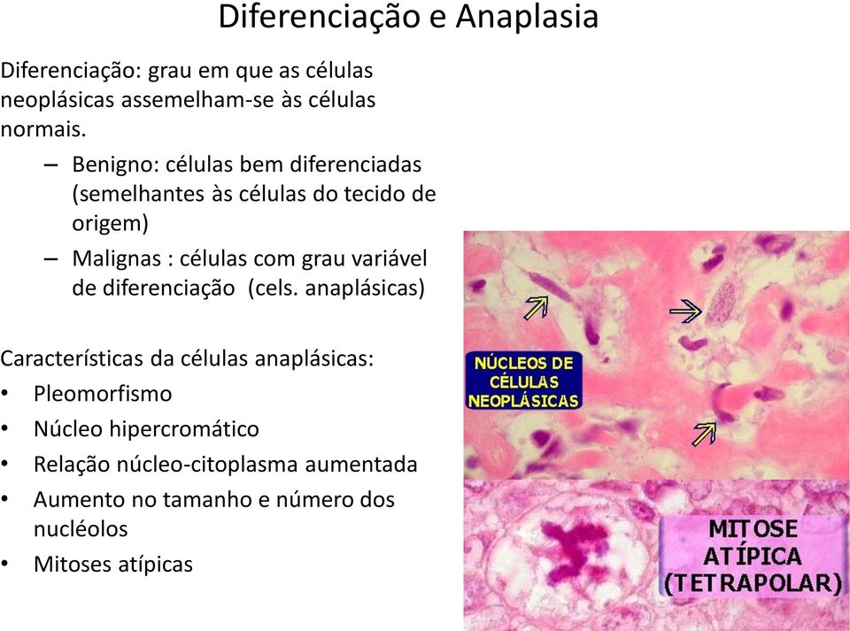 Malignas : células com grau variável de diferenciação (cels.