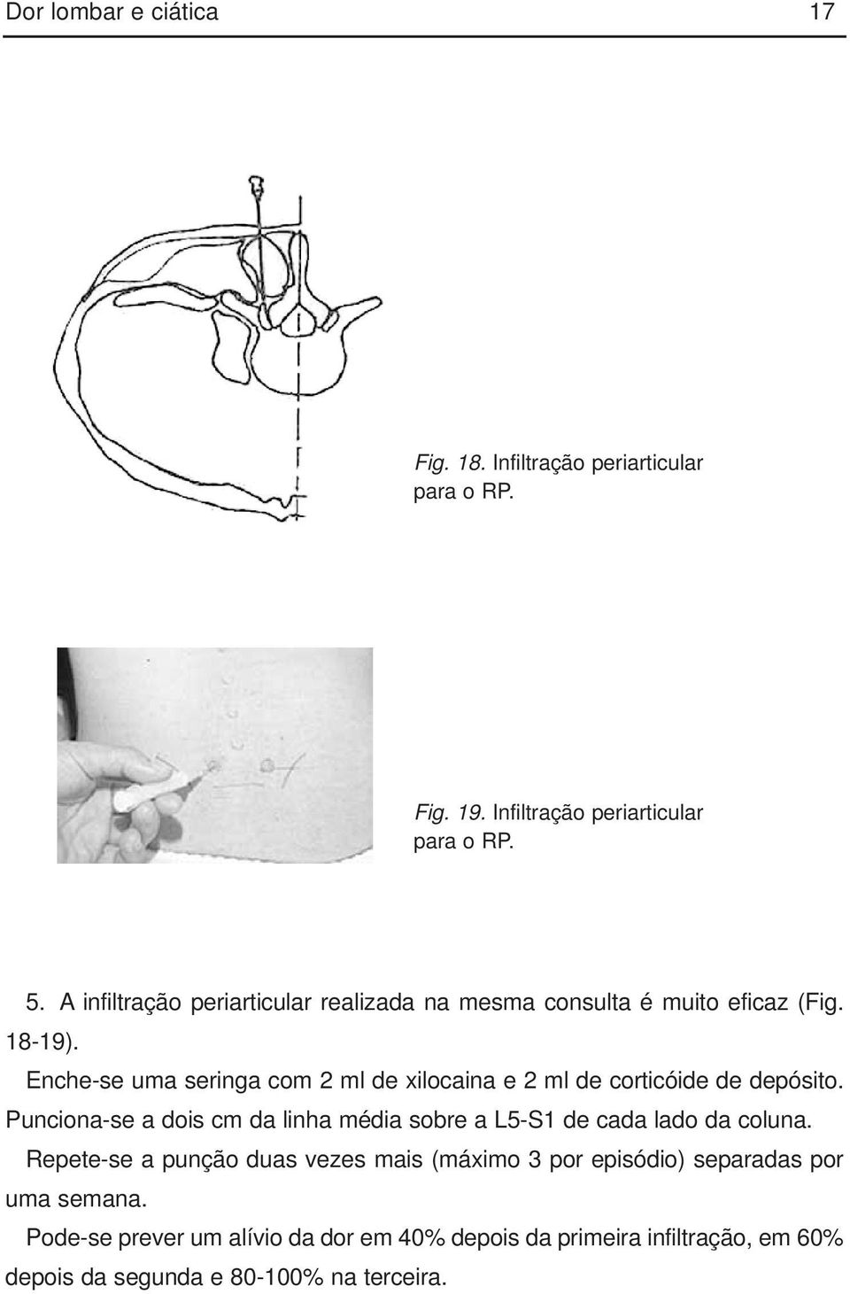 Enche-se uma seringa com 2 ml de xilocaina e 2 ml de corticóide de depósito.