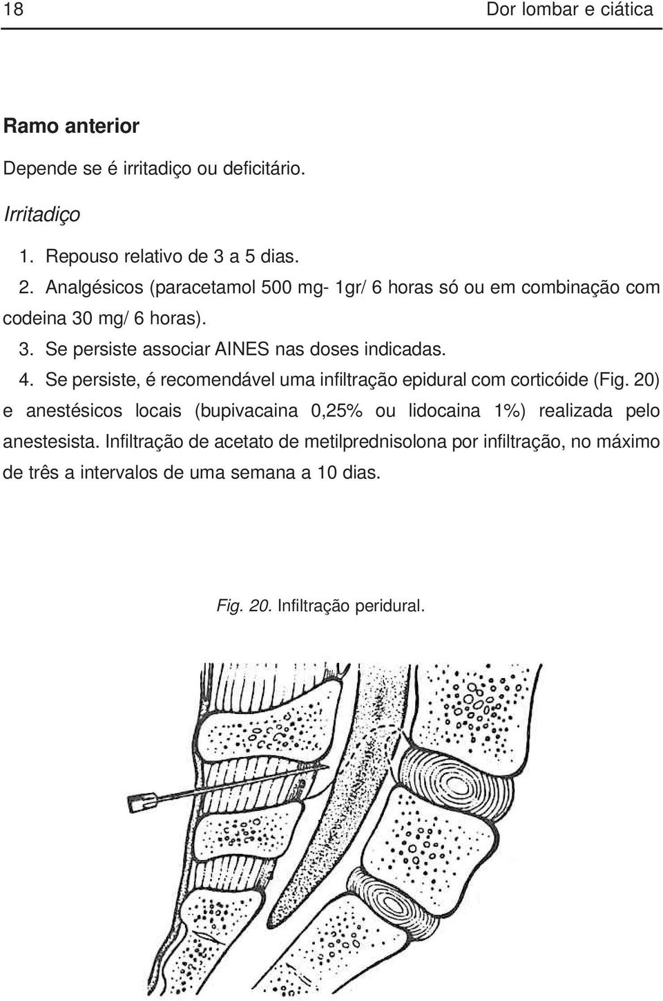 4. Se persiste, é recomendável uma infiltração epidural com corticóide (Fig.