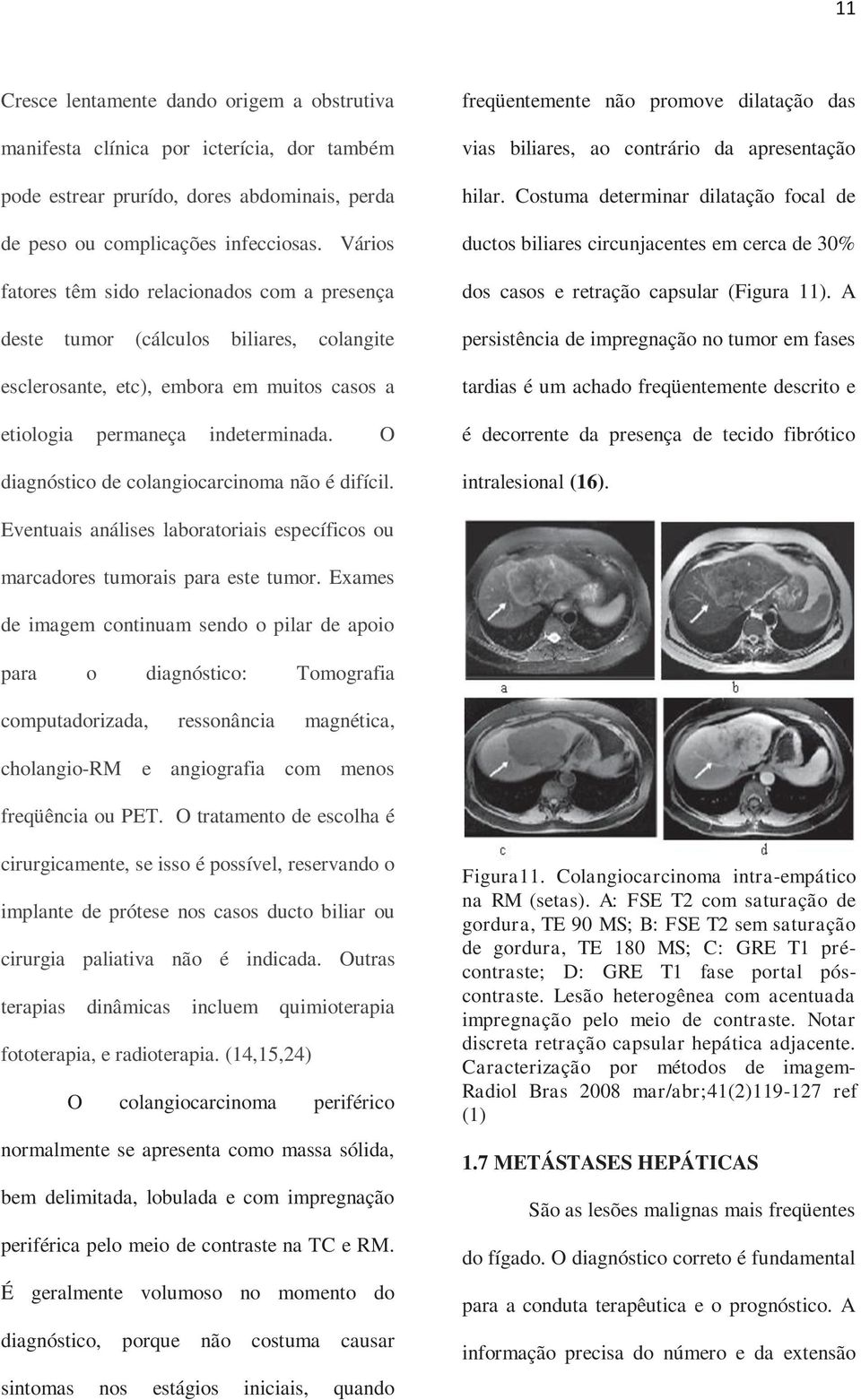 O diagnóstico de colangiocarcinoma não é difícil. freqüentemente não promove dilatação das vias biliares, ao contrário da apresentação hilar.