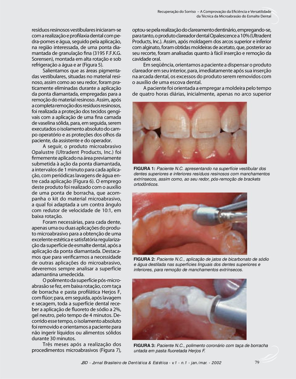 Salientamos que as áreas pigmentadas vestibulares, situadas no material resinoso, assim como ao seu redor, foram praticamente eliminadas durante a aplicação da ponta diamantada, empregadas para a