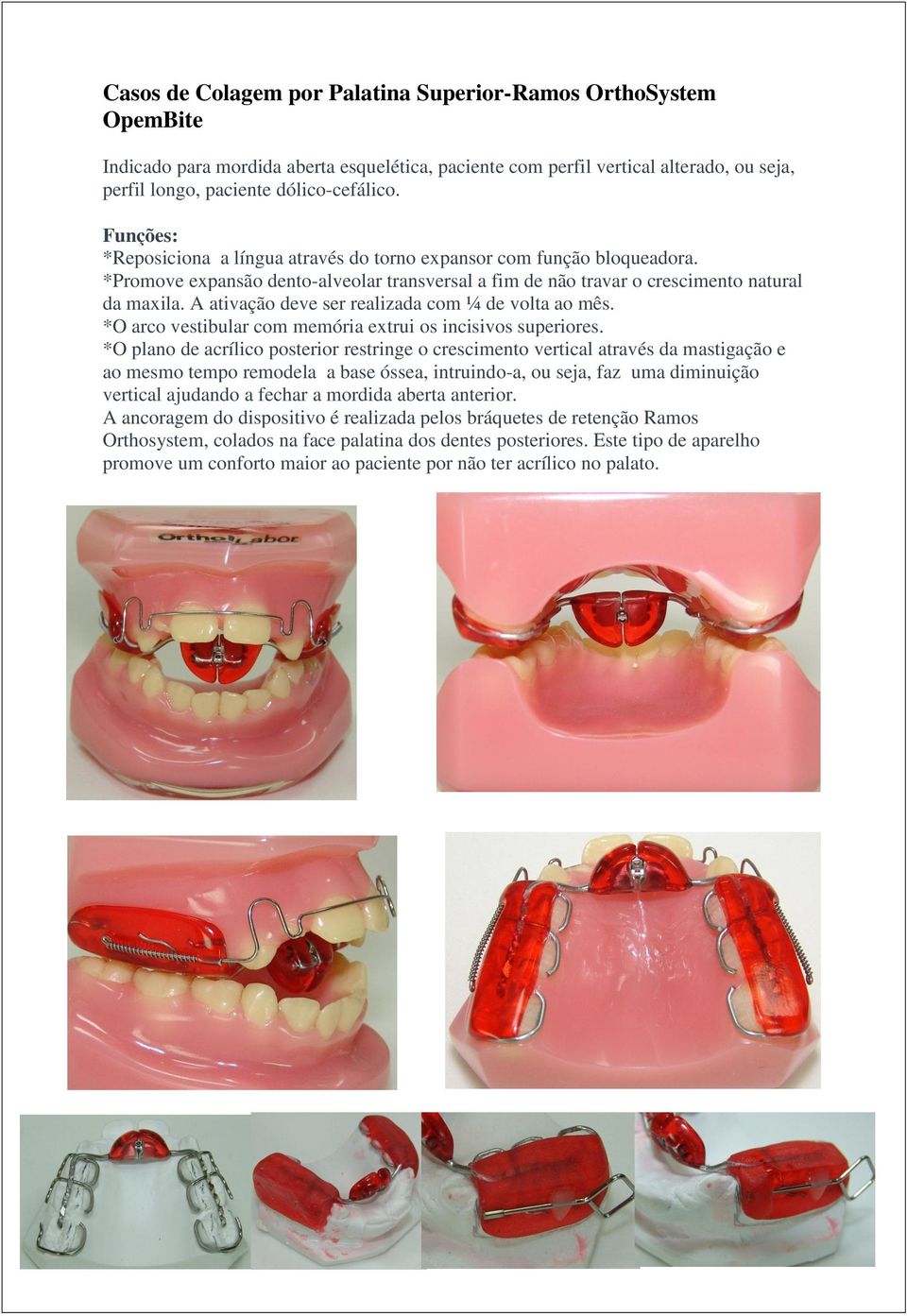 A ativação deve ser realizada com ¼ de volta ao mês. *O arco vestibular com memória extrui os incisivos superiores.