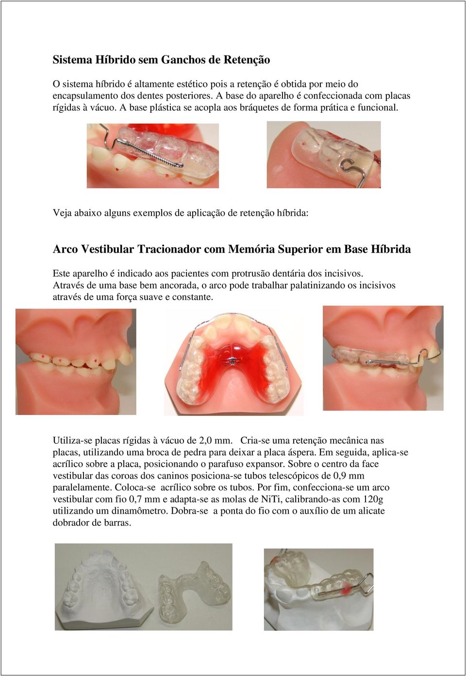Veja abaixo alguns exemplos de aplicação de retenção híbrida: Arco Vestibular Tracionador com Memória Superior em Base Híbrida Este aparelho é indicado aos pacientes com protrusão dentária dos