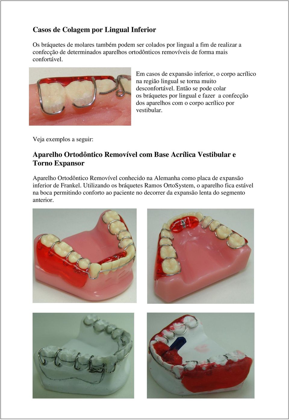 Então se pode colar os bráquetes por lingual e fazer a confecção dos aparelhos com o corpo acrílico por vestibular.