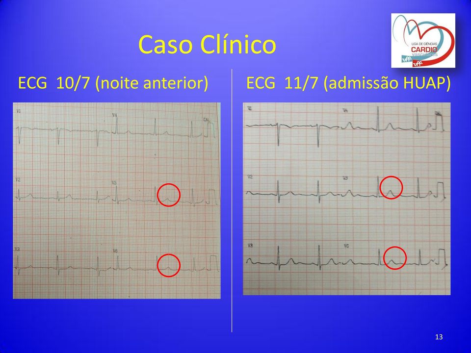 anterior) ECG