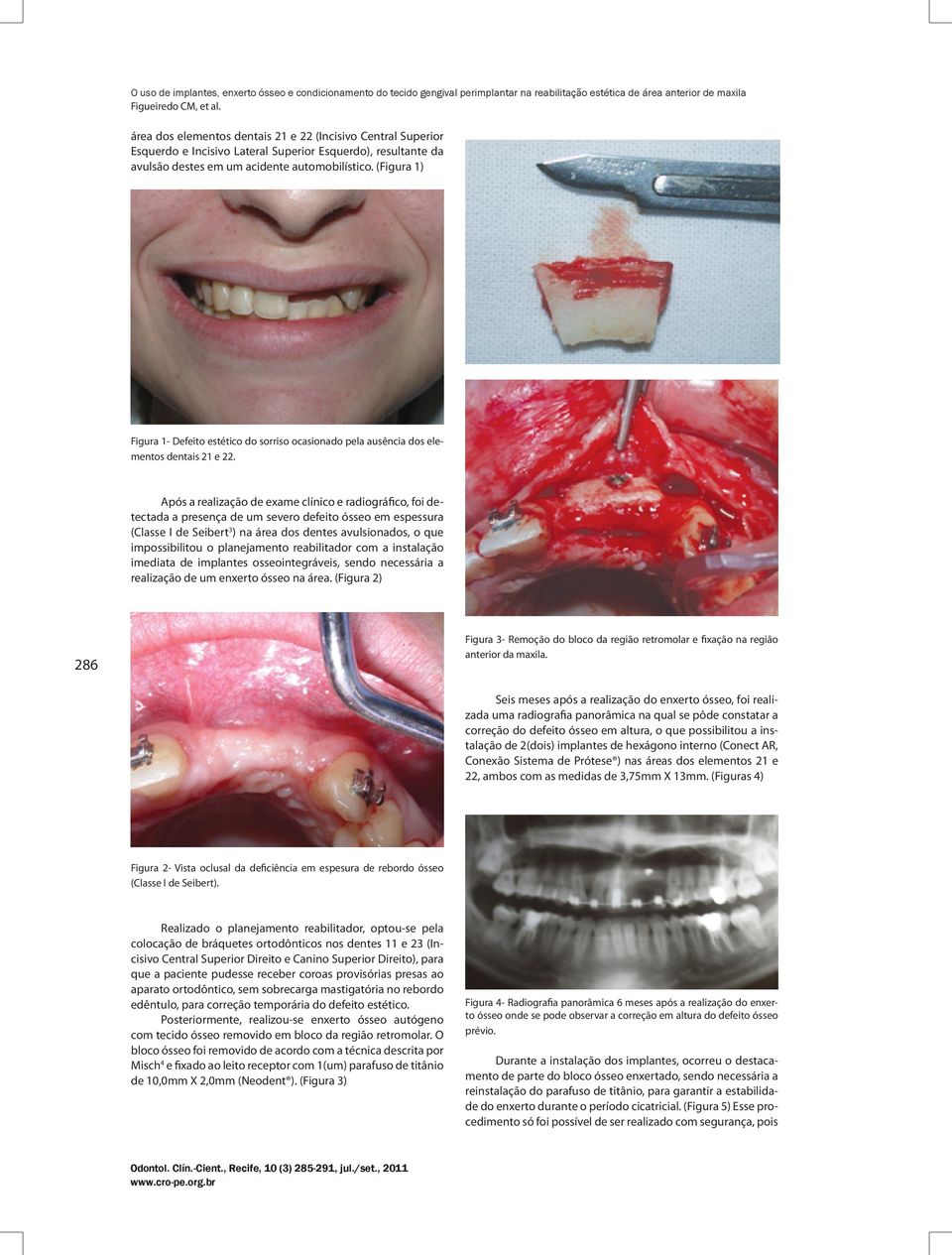 Após a realização de exame clínico e radiográfico, foi detectada a presença de um severo defeito ósseo em espessura (Classe I de Seibert 3 ) na área dos dentes avulsionados, o que impossibilitou o