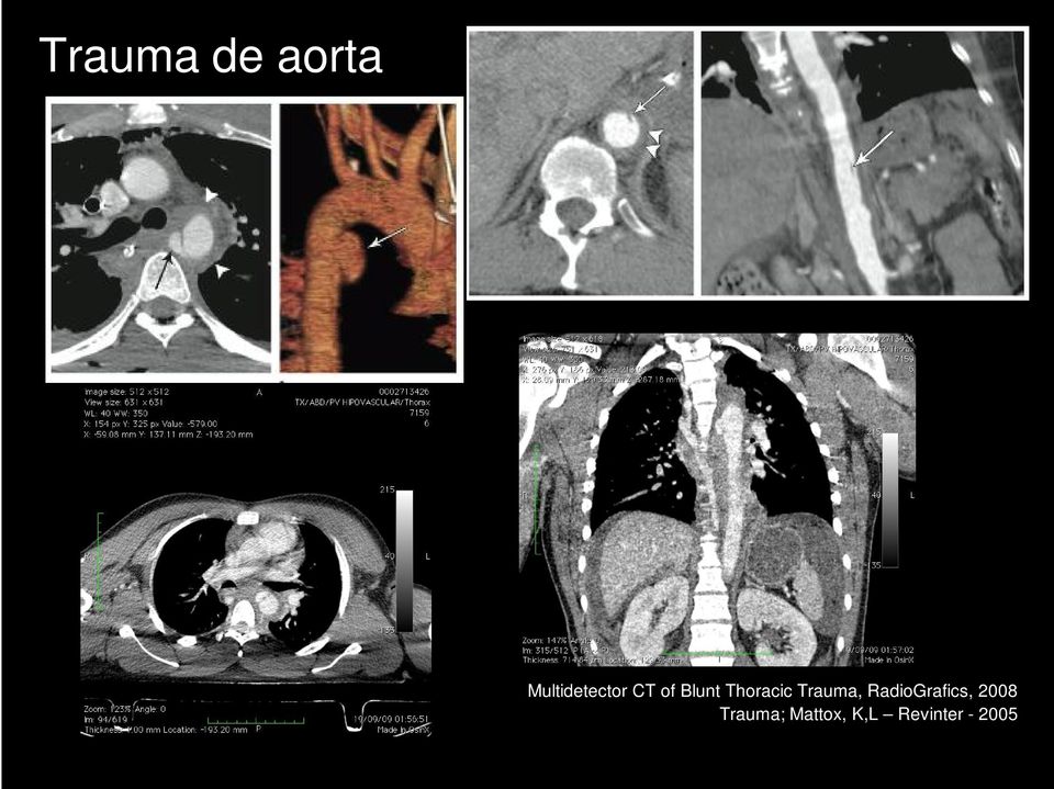 Thoracic Trauma,