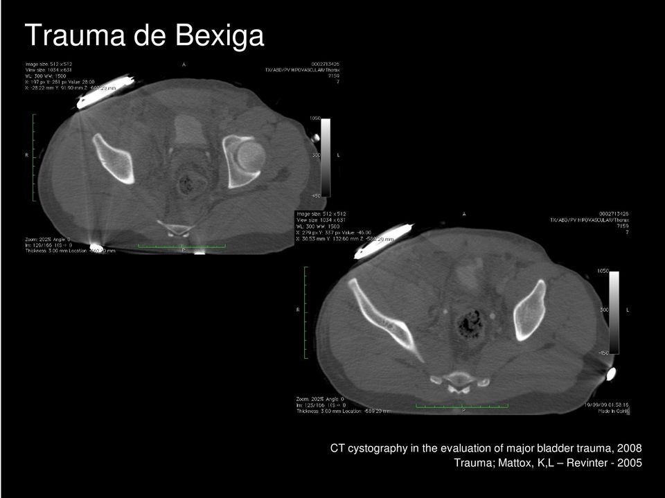 of major bladder trauma, 2008