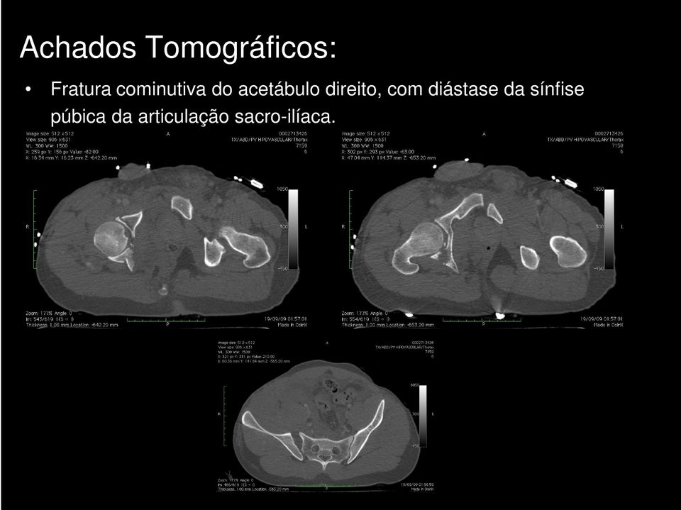 direito, com diástase da