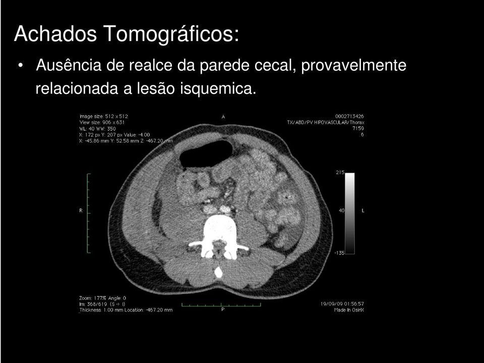 parede cecal,