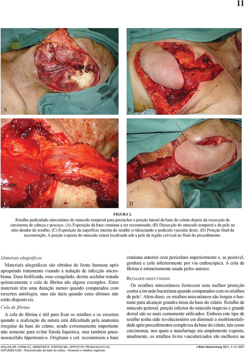 vascular deste; (D) Posição final da reconstrução. A porção exposta do músculo estará localizada sob a pele da região cervical ao final do procedimento.