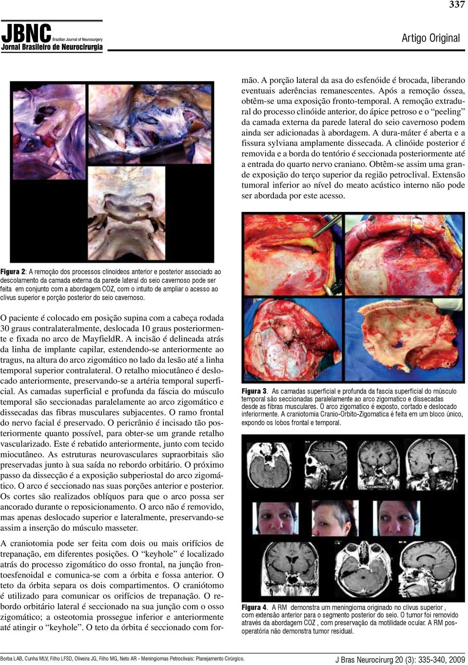 O retalho miocutâneo é deslocado anteriormente, preservando-se a artéria temporal superficial.