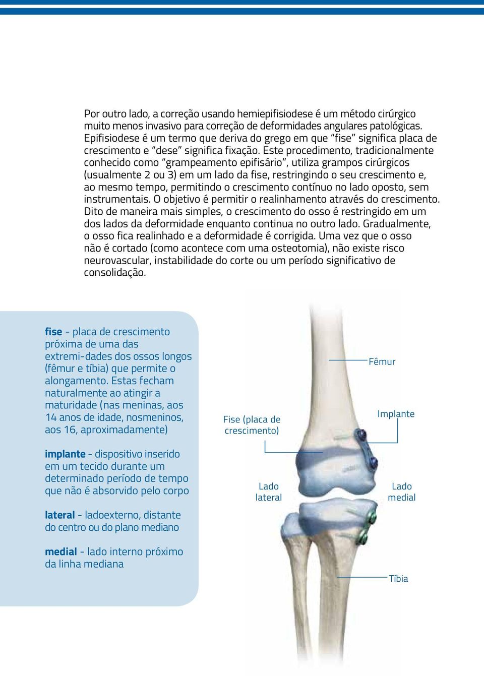 Este procedimento, tradicionalmente conhecido como grampeamento epifisário, utiliza grampos cirúrgicos (usualmente 2 ou 3) em um lado da fise, restringindo o seu crescimento e, ao mesmo tempo,