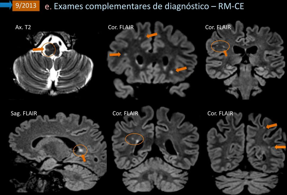 diagnóstico RM-CE Ax. T2 Cor.