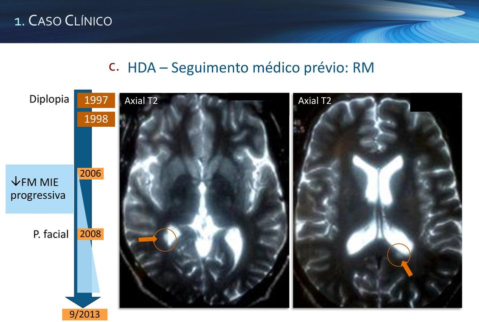 Diplopia 1997 Axial T2 Axial T2