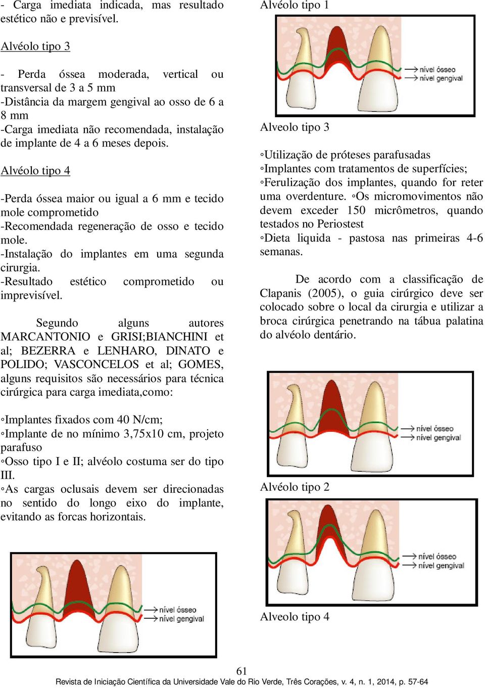 4 a 6 meses depois. Alvéolo tipo 4 -Perda óssea maior ou igual a 6 mm e tecido mole comprometido -Recomendada regeneração de osso e tecido mole. -Instalação do implantes em uma segunda cirurgia.