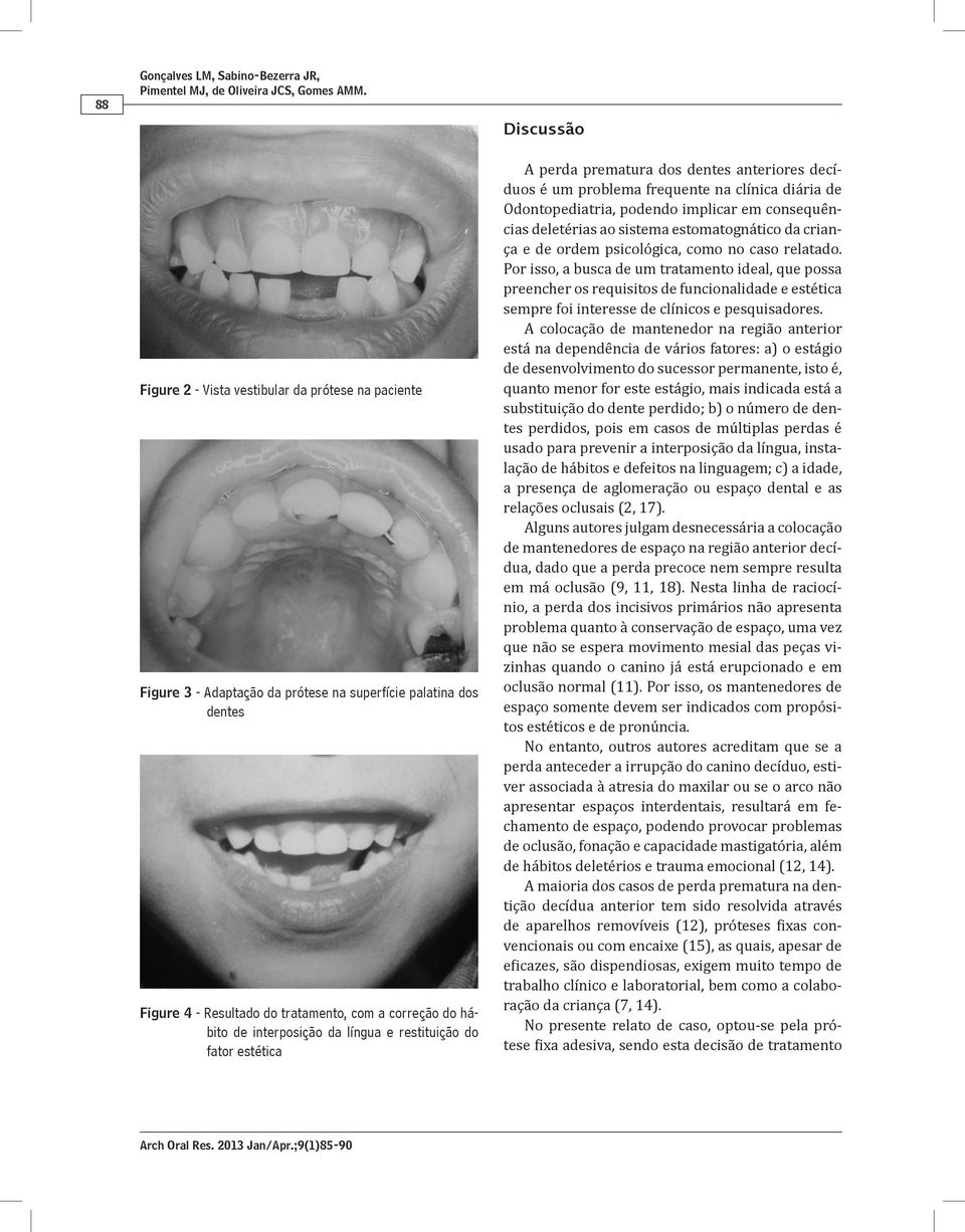 interposição da língua e restituição do fator estética A perda prematura dos dentes anteriores decíduos é um problema frequente na clínica diária de Odontopediatria, podendo implicar em consequências